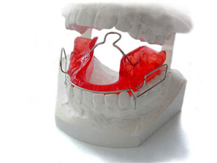 Behandlung lose Zahnspangen